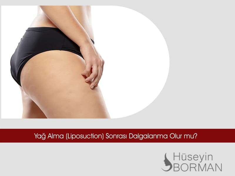 yag-alma-liposuction