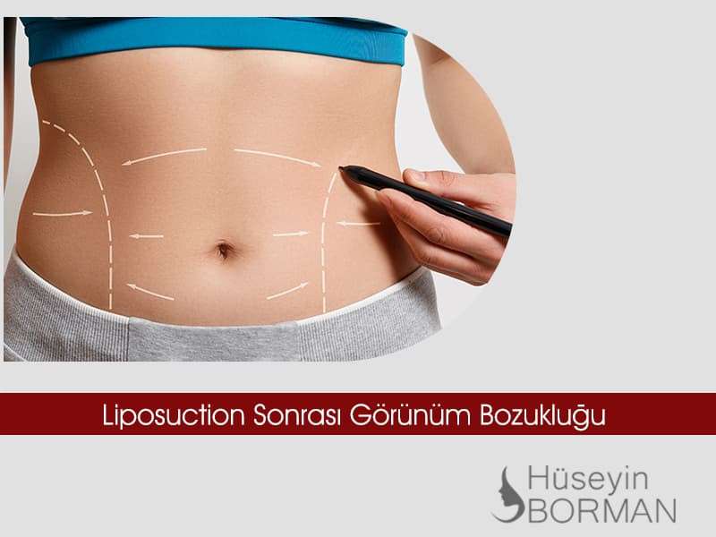 liposuction-yag-alma
