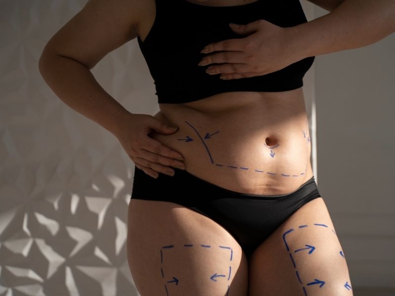 liposuction-kimlere-uygulanir.