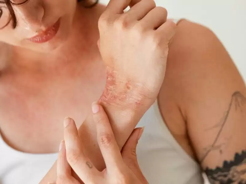 ankara-yanik-tedavisi